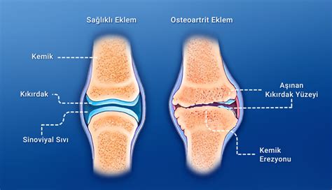 osteoartrit artroz dejeneratif eklem hastalığı